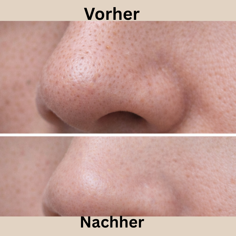 Ultrasonic Skin Scrubber - Tiefenreinigung & Gesichtspeeling